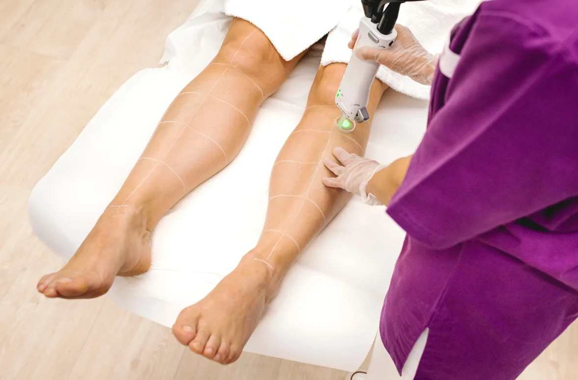 QUELS SONT LES BÉNÉFICES DE L’ÉPILATION LASER ?